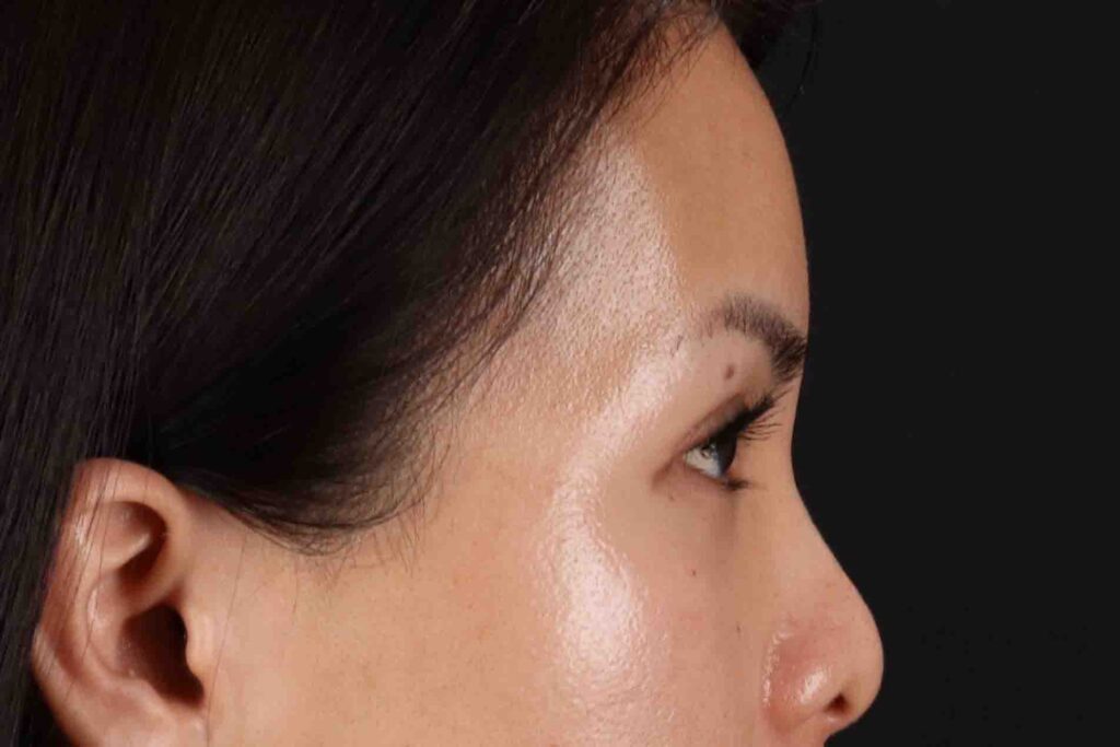 After - right_lateral