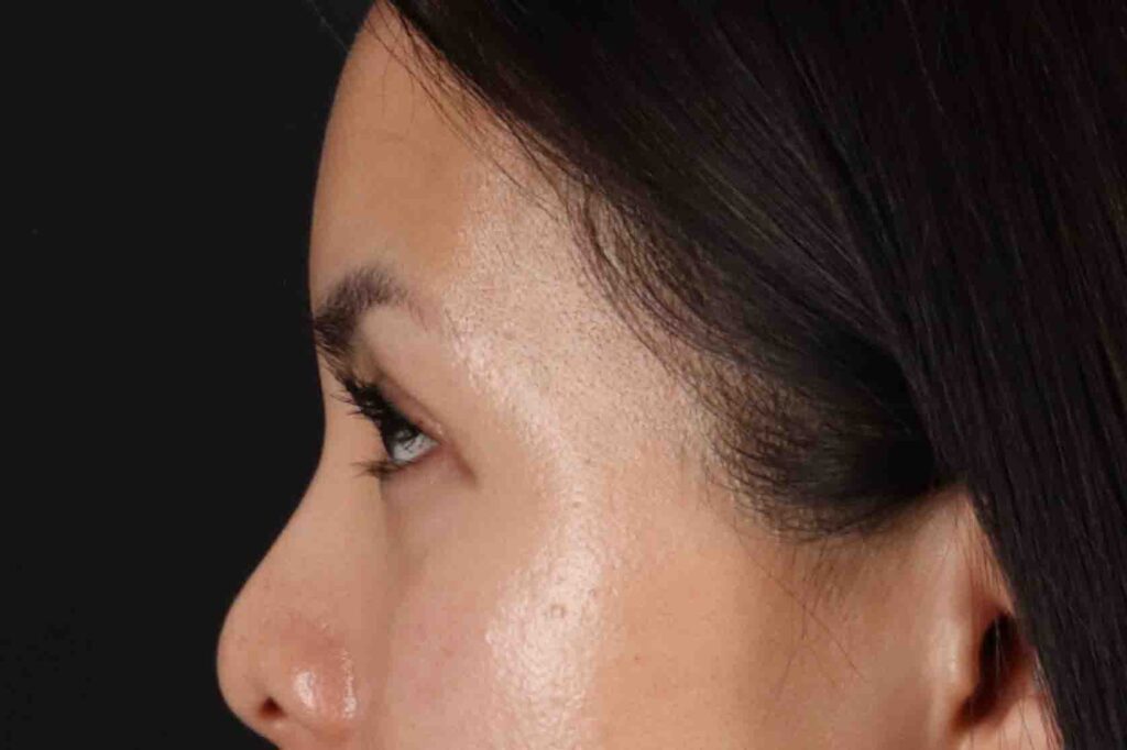 After - left_lateral