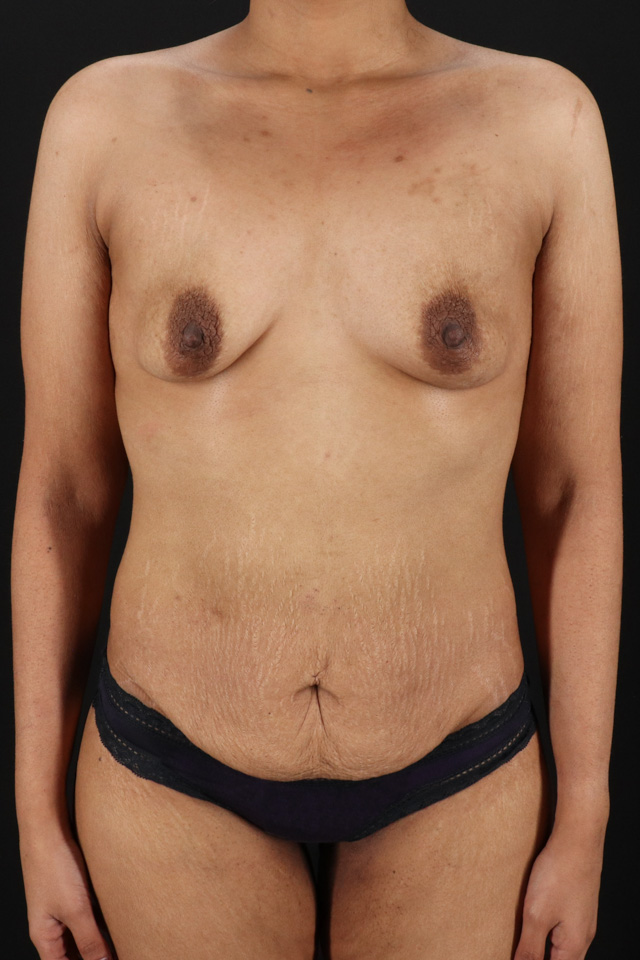 Before - 3394