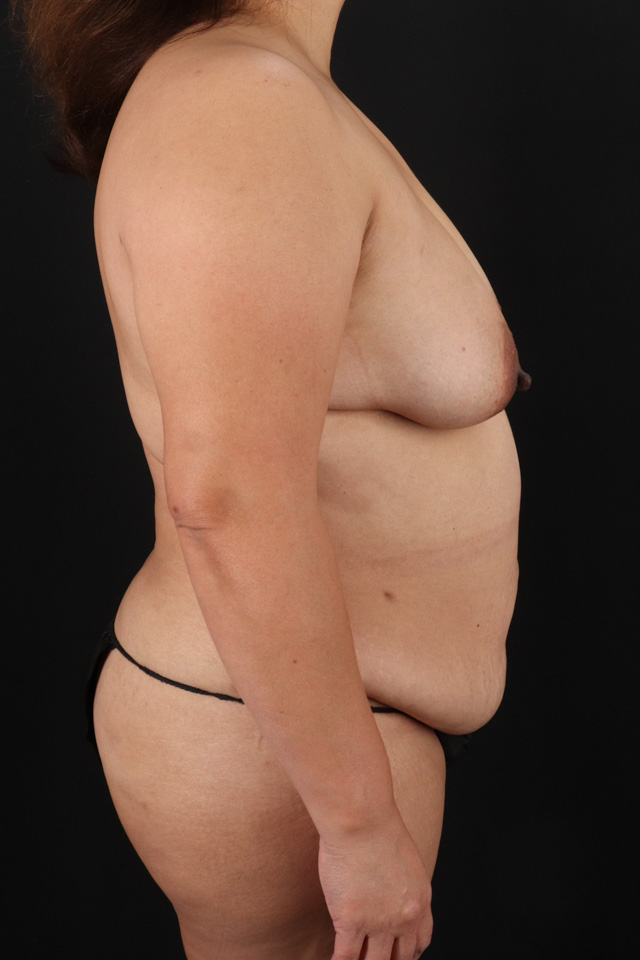 Before - right_lateral