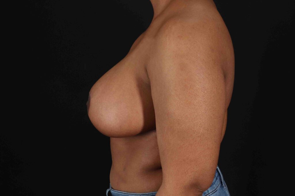 After - left_lateral