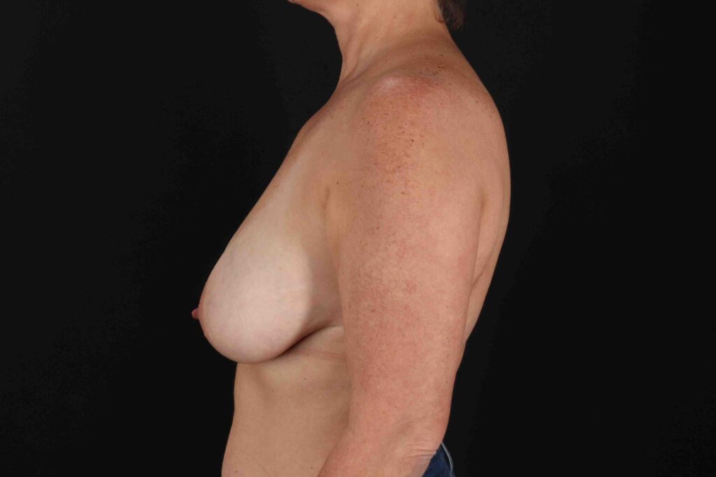 Before - left_lateral