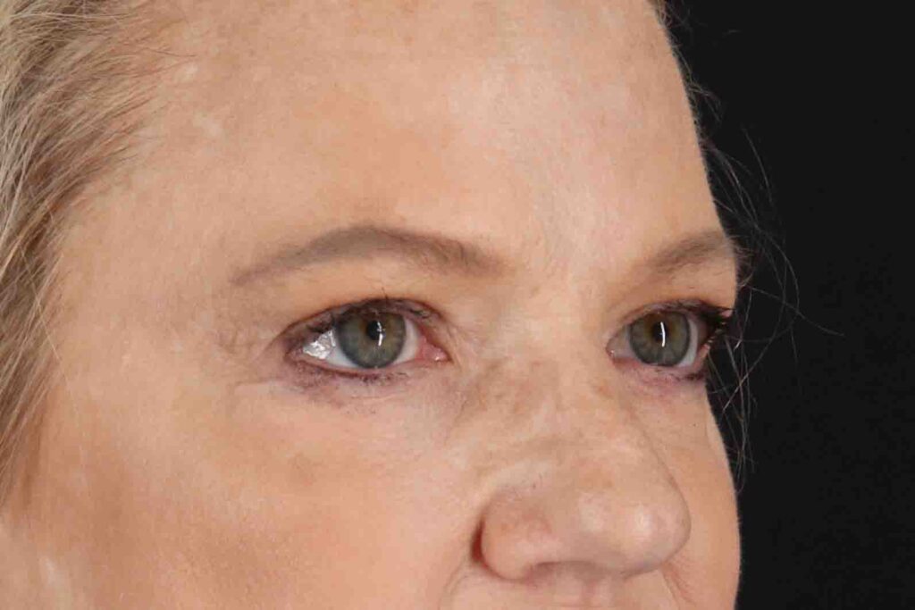 After - right_oblique