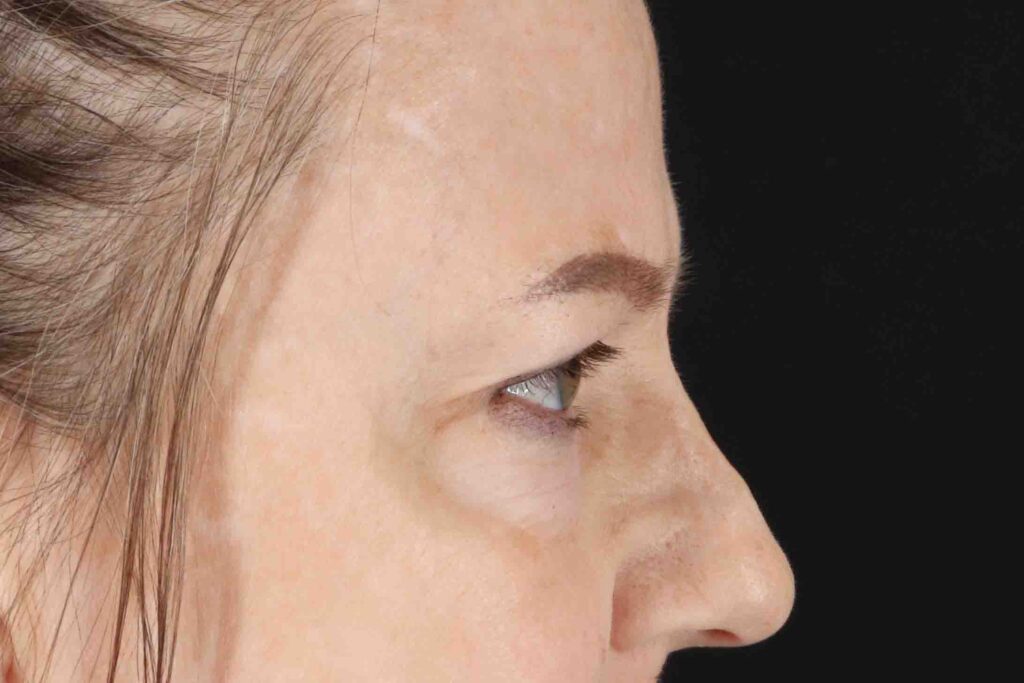 Before - right_lateral