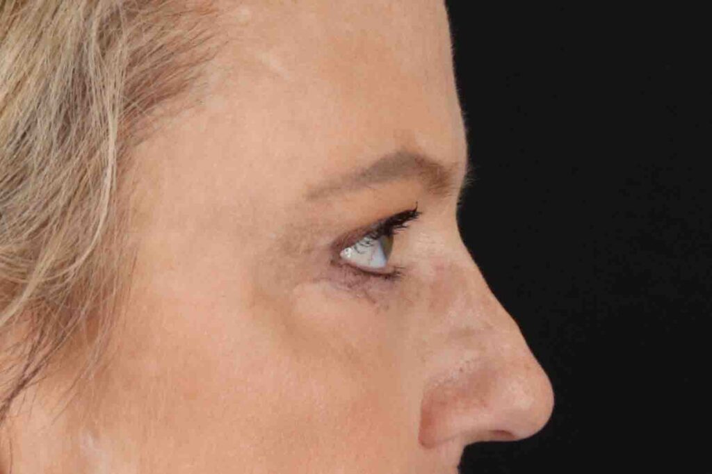 After - right_lateral