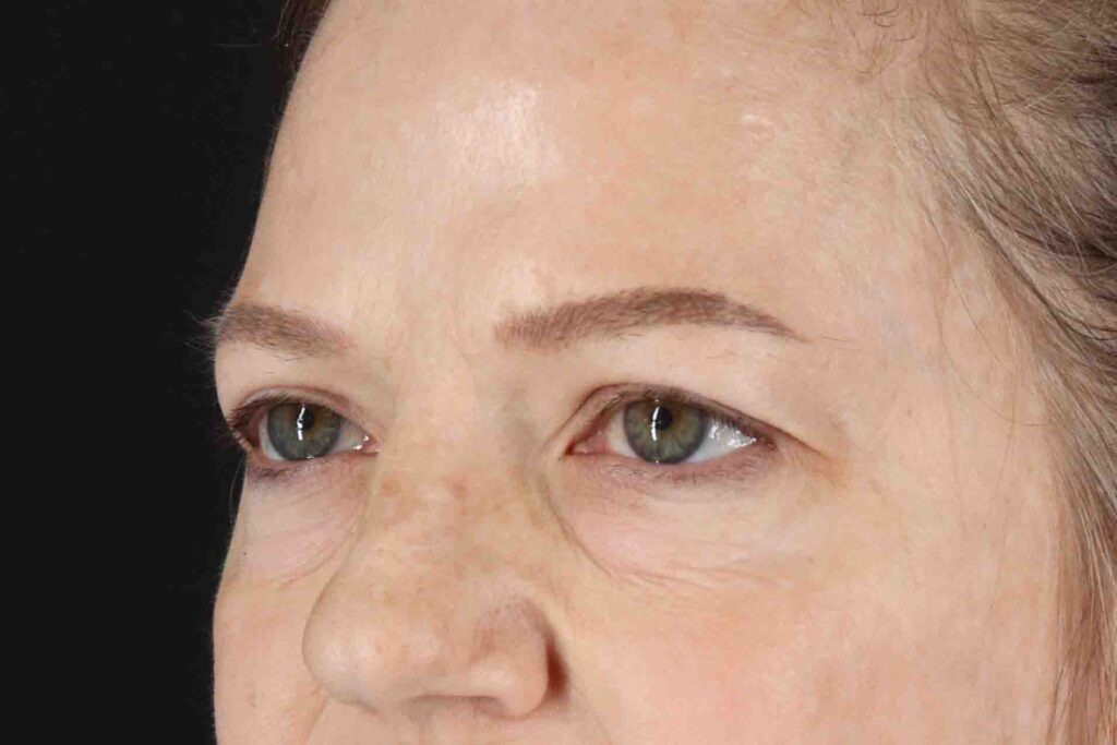 Before - left_oblique