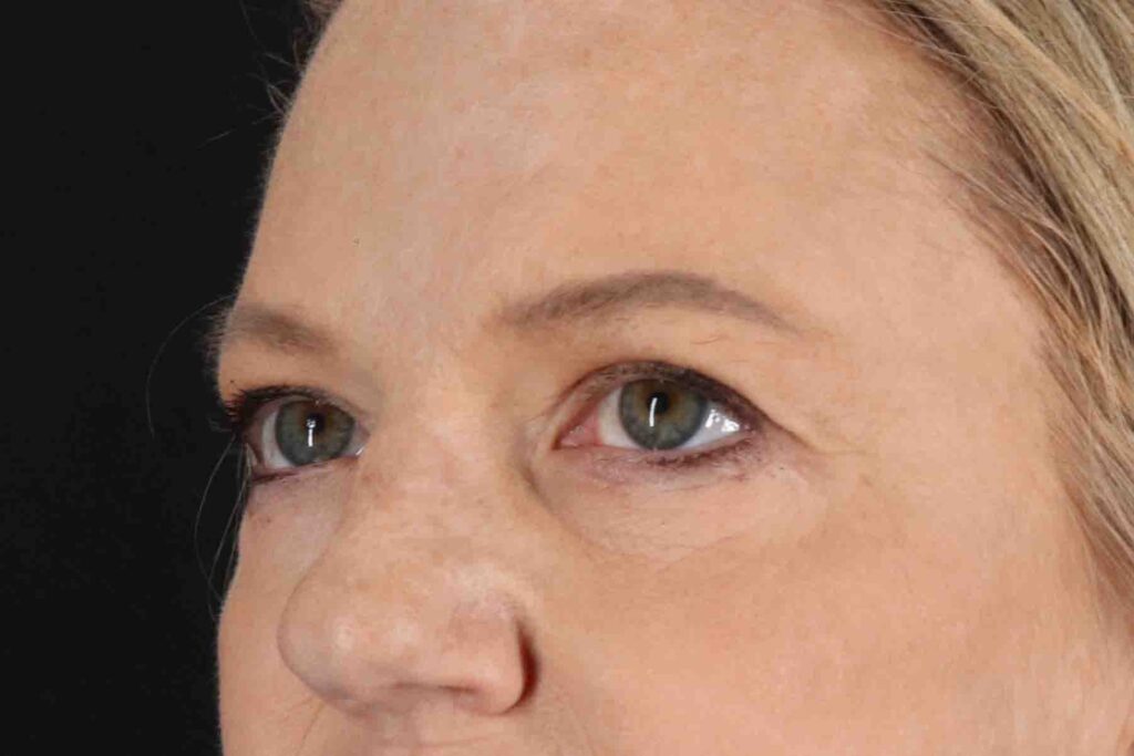 After - left_oblique