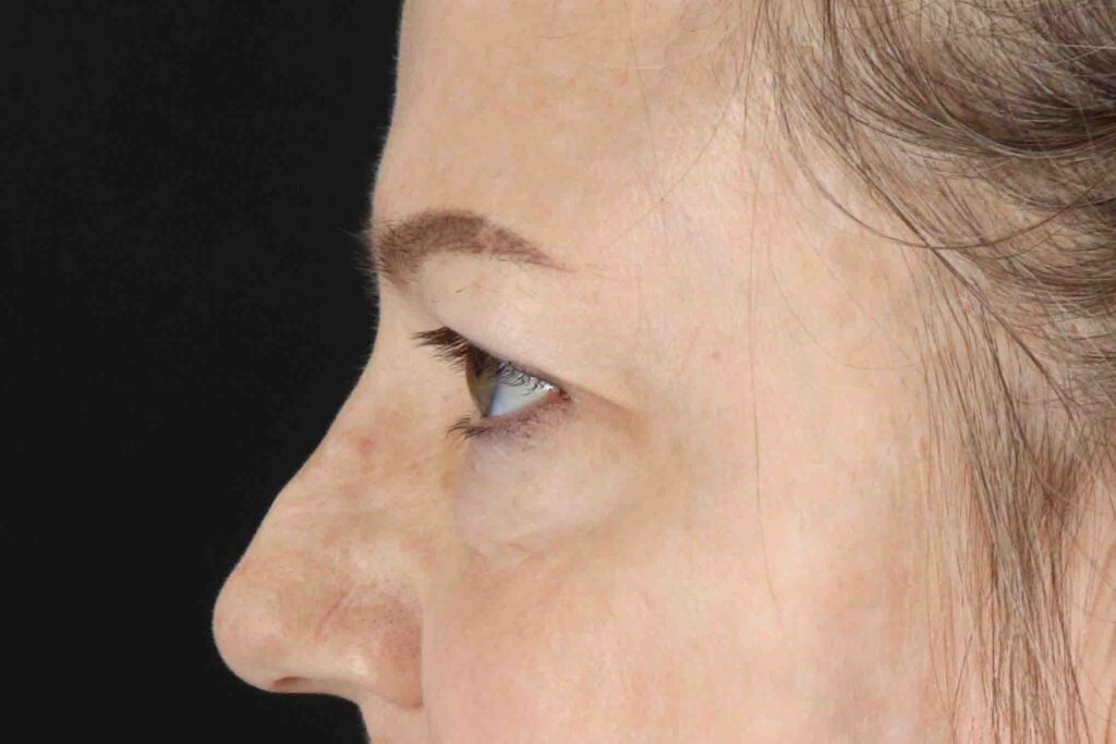 Before - left_lateral