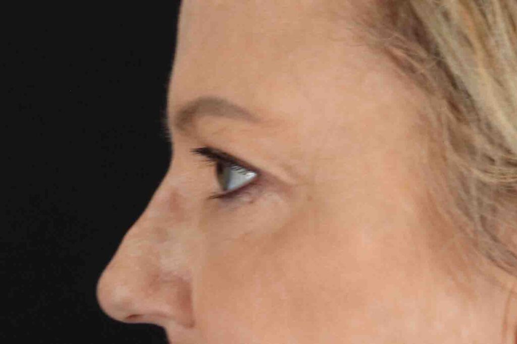 After - left_lateral