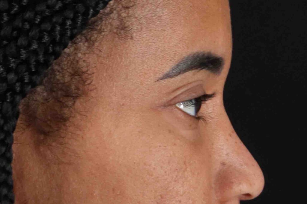 Before - right_lateral