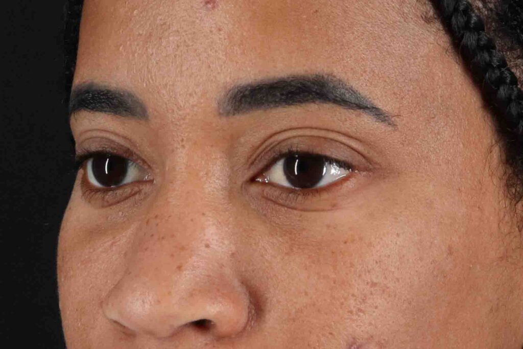 Before - left_oblique