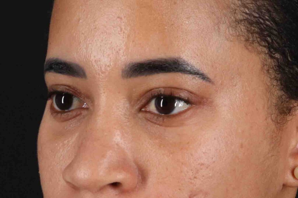 After - left_oblique