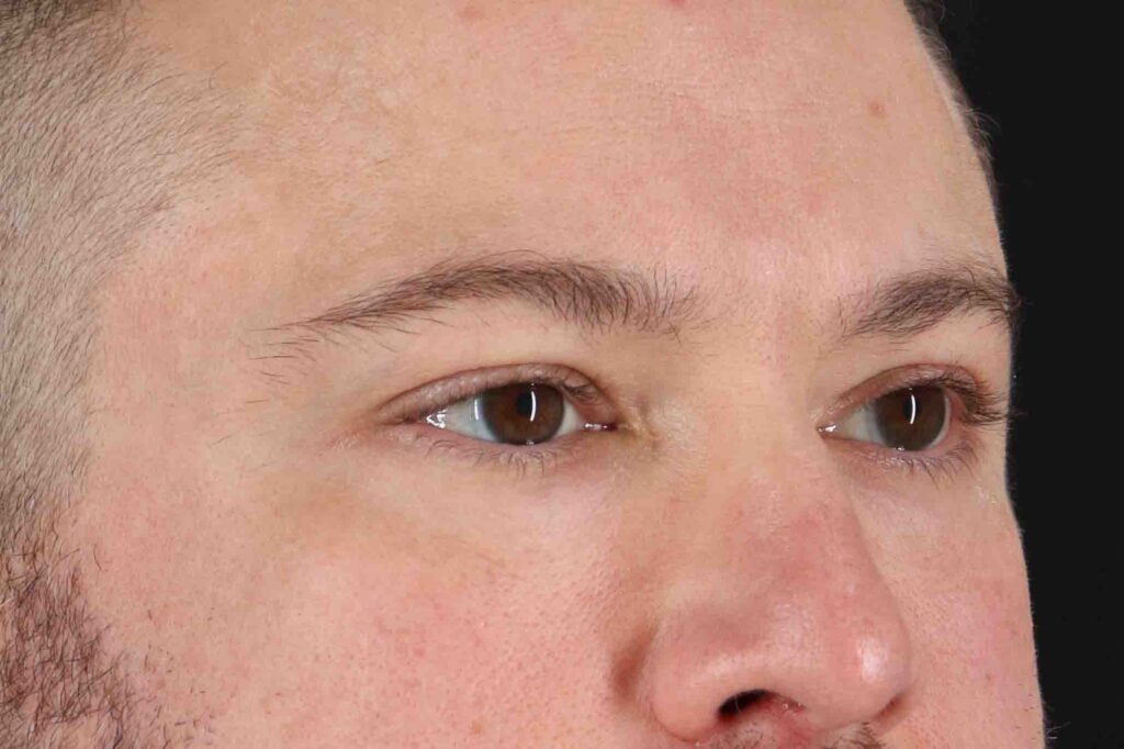 After - right_oblique