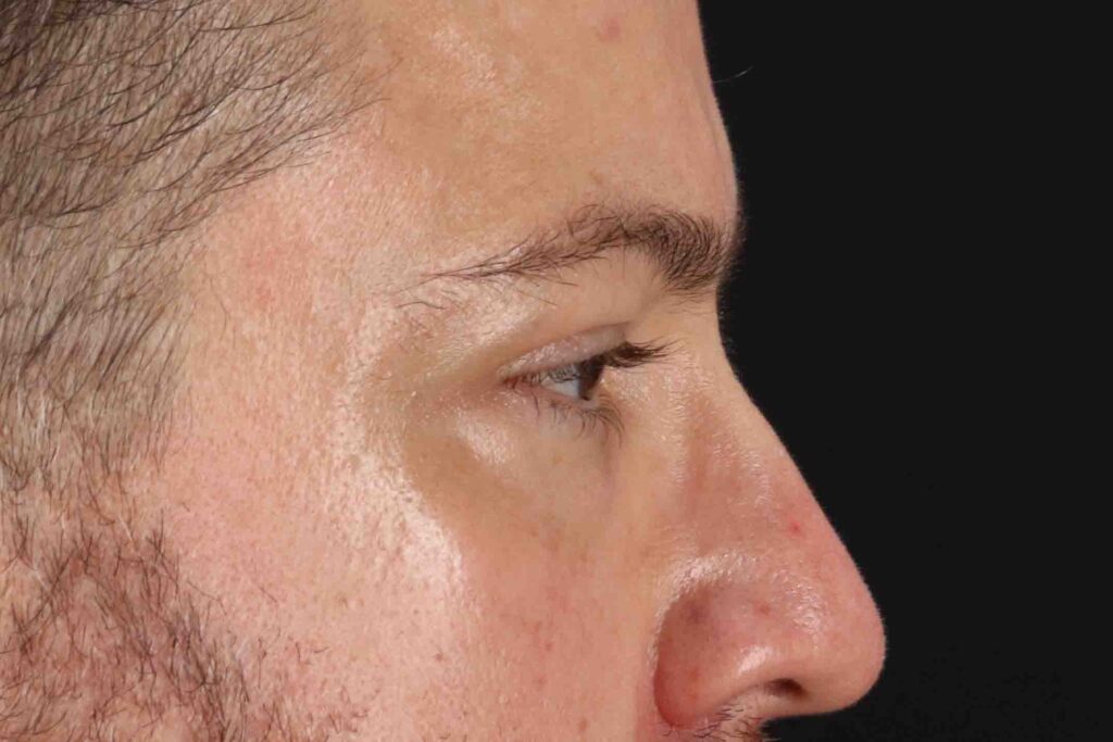 Before - right_lateral