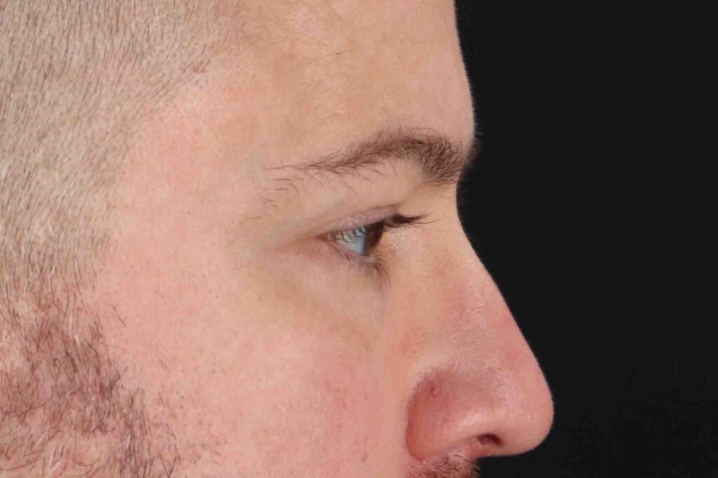 After - right_lateral