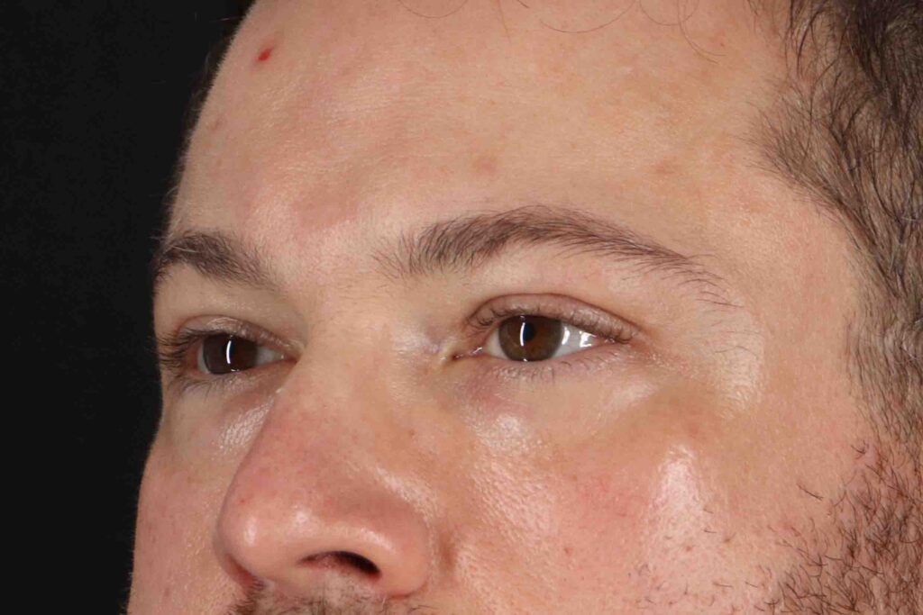 Before - left_oblique