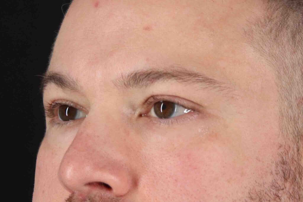 After - left_oblique