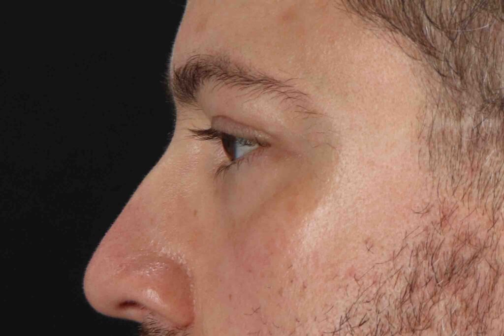 Before - left_lateral