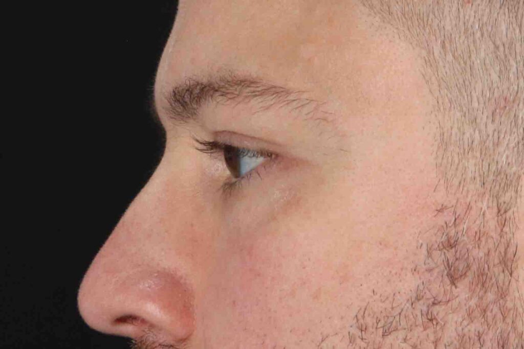 After - left_lateral