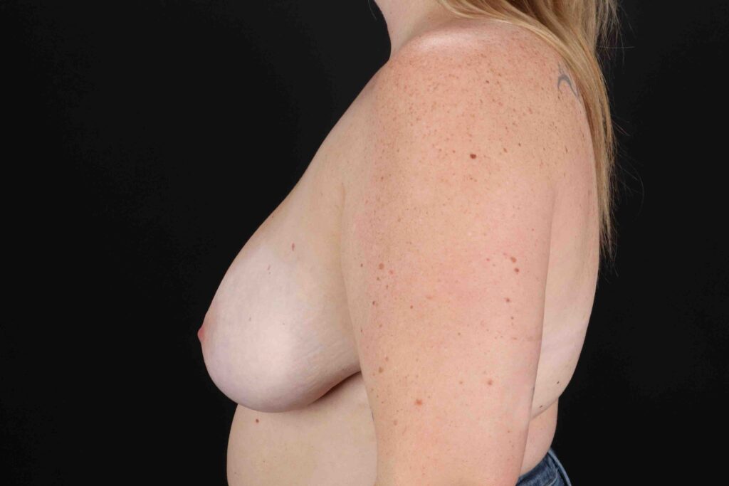 Before - left_lateral