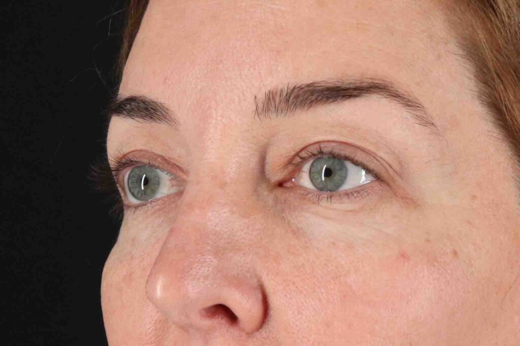 Before - left_oblique