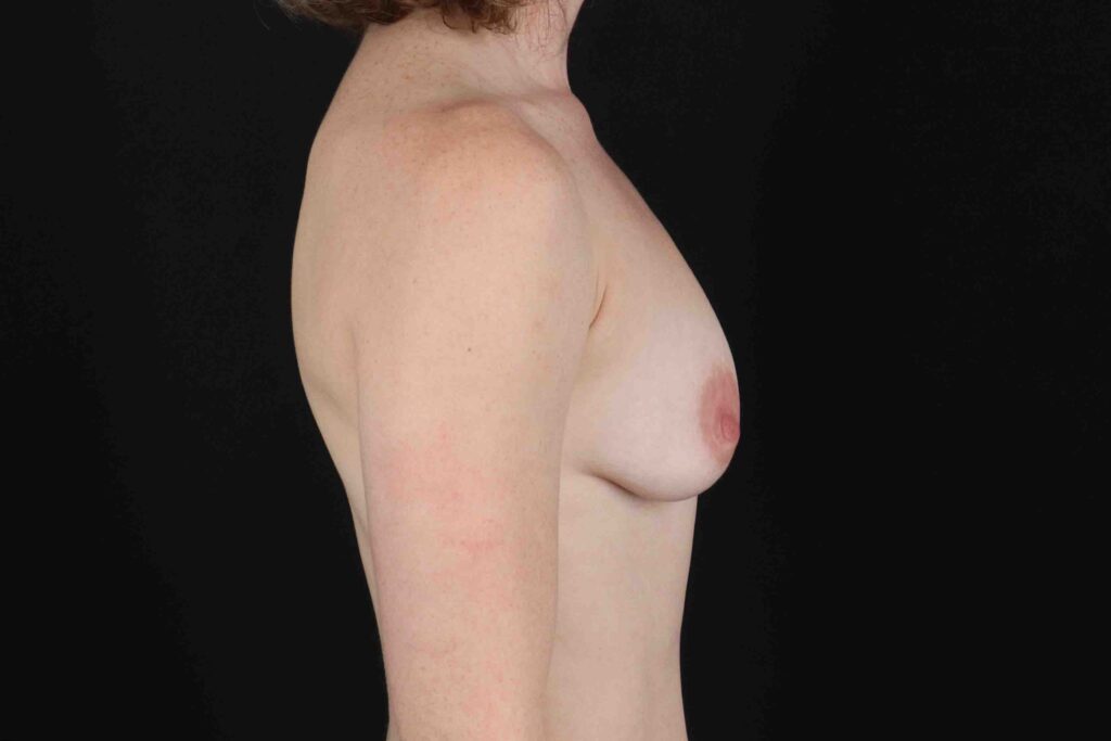 Before - right_lateral