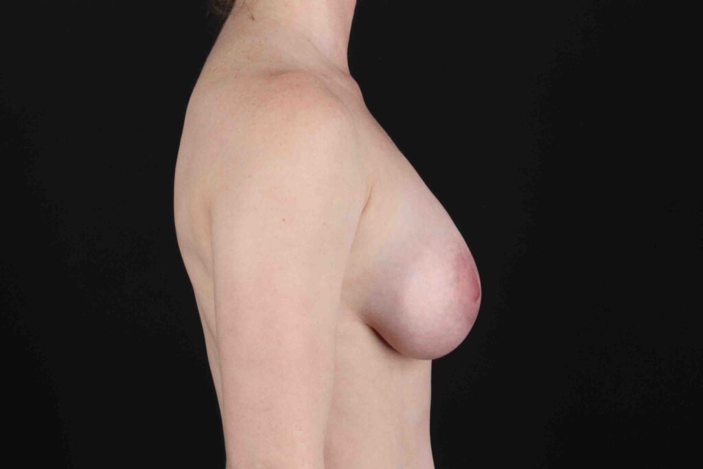 After - right_lateral