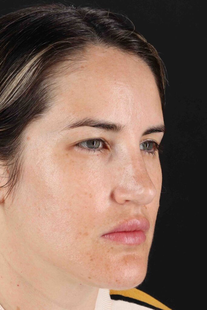 Before - right_oblique