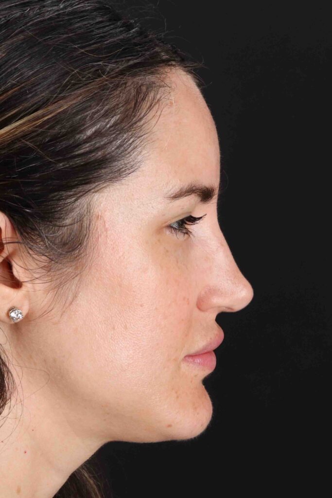 After - right_lateral