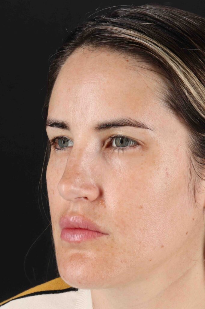 Before - left_oblique