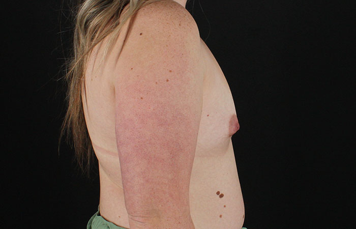 Before - right_lateral