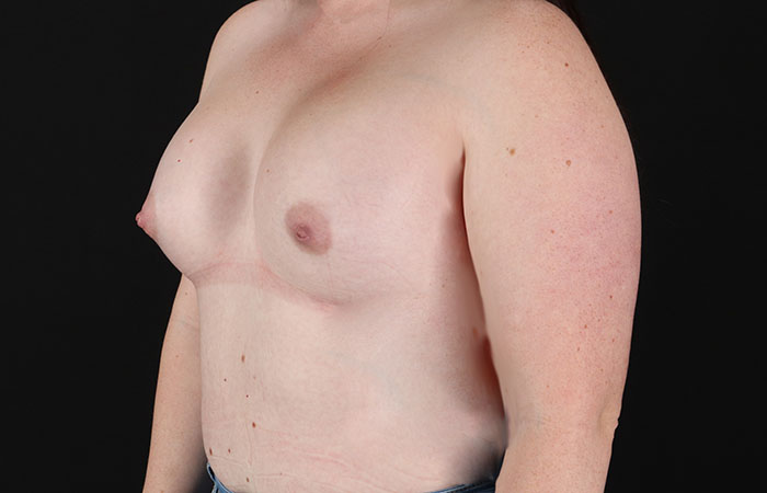 After - left_oblique