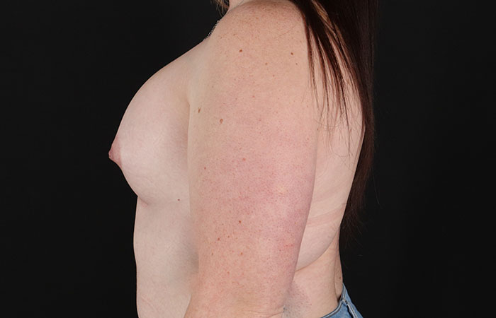 After - left_lateral