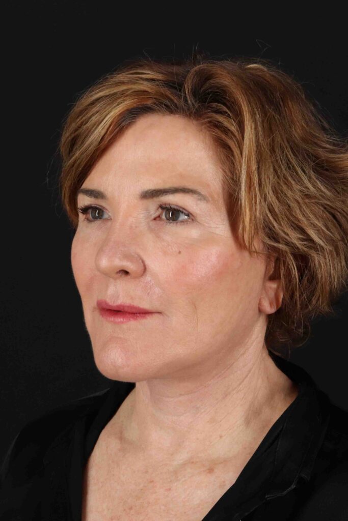 After - left_oblique