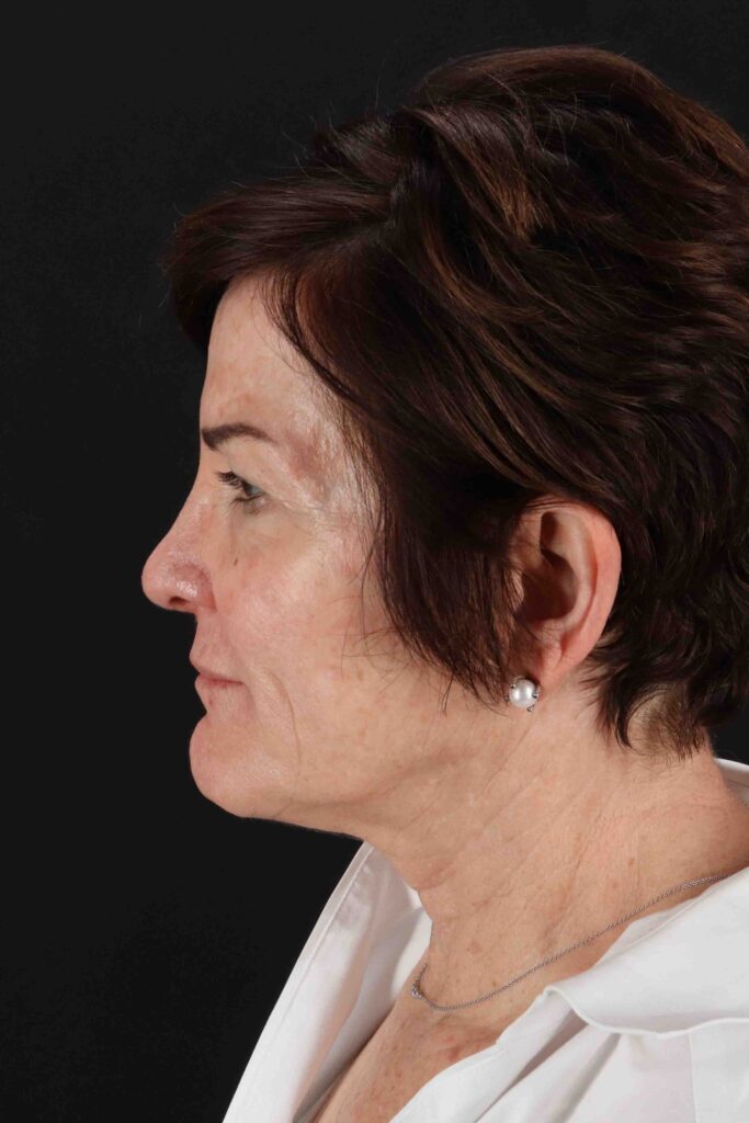 Before - left_lateral