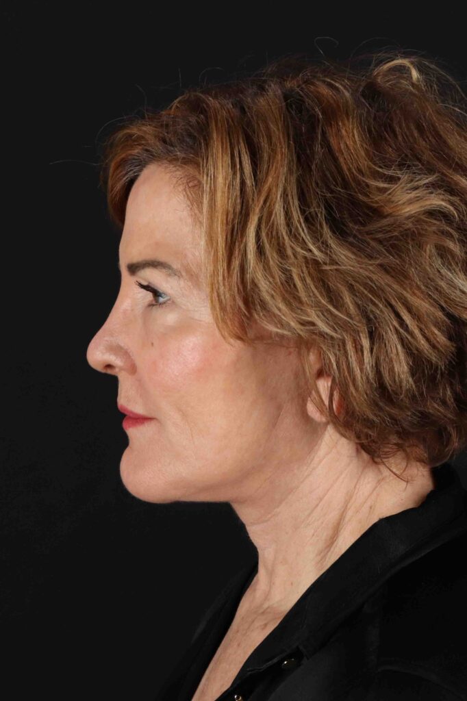 After - left_lateral