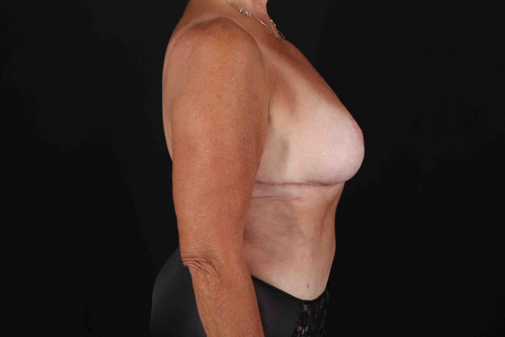 After - right_lateral