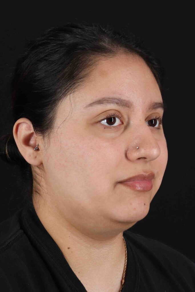 Before - right_oblique