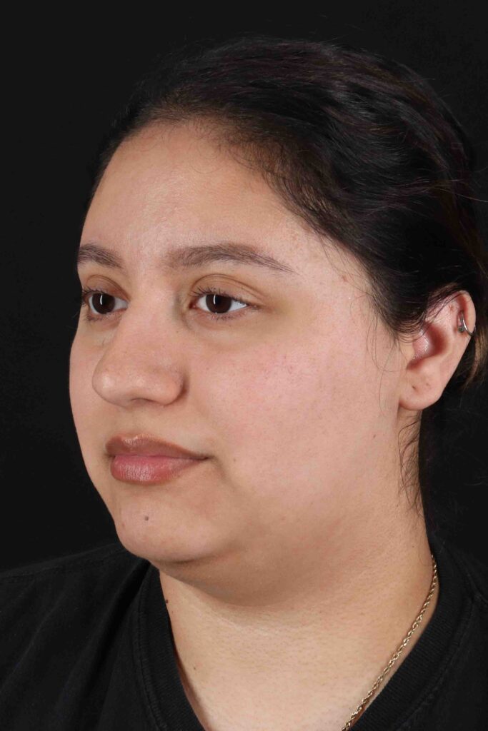 Before - left_oblique