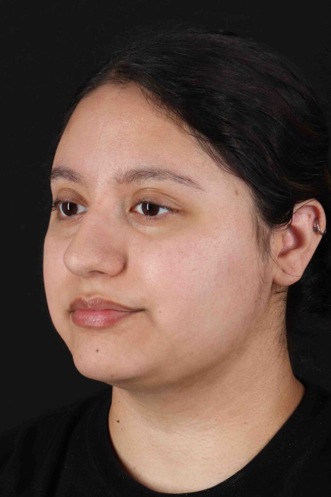 After - left_oblique