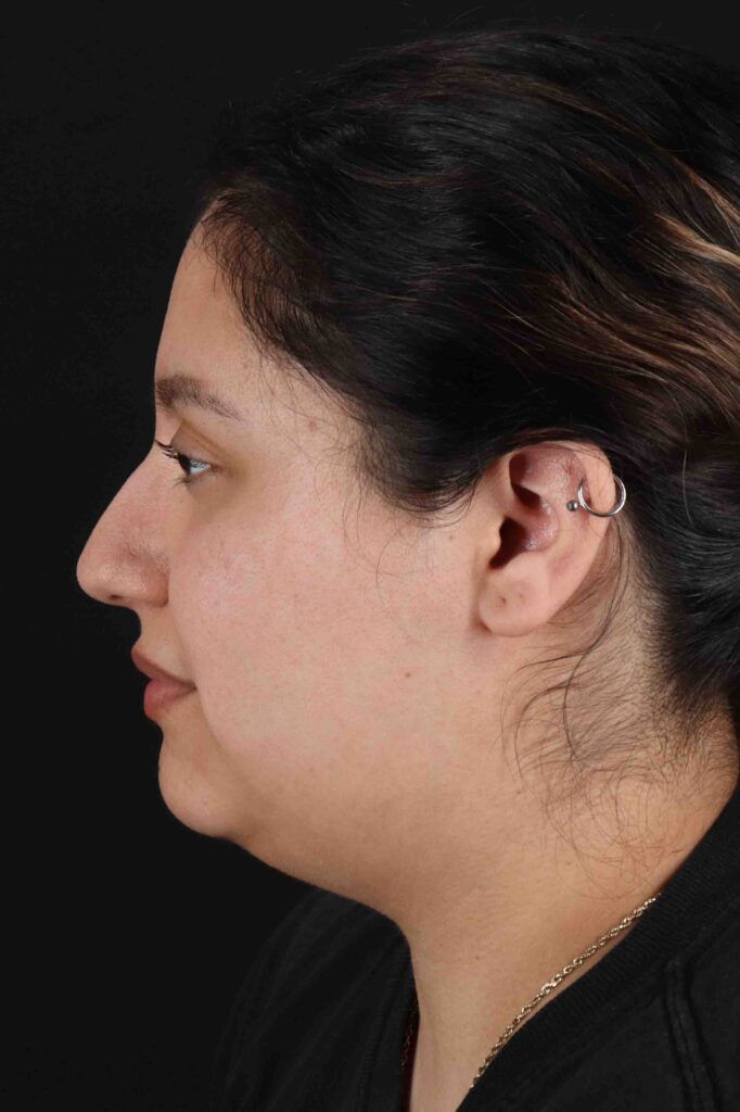 Before - left_lateral