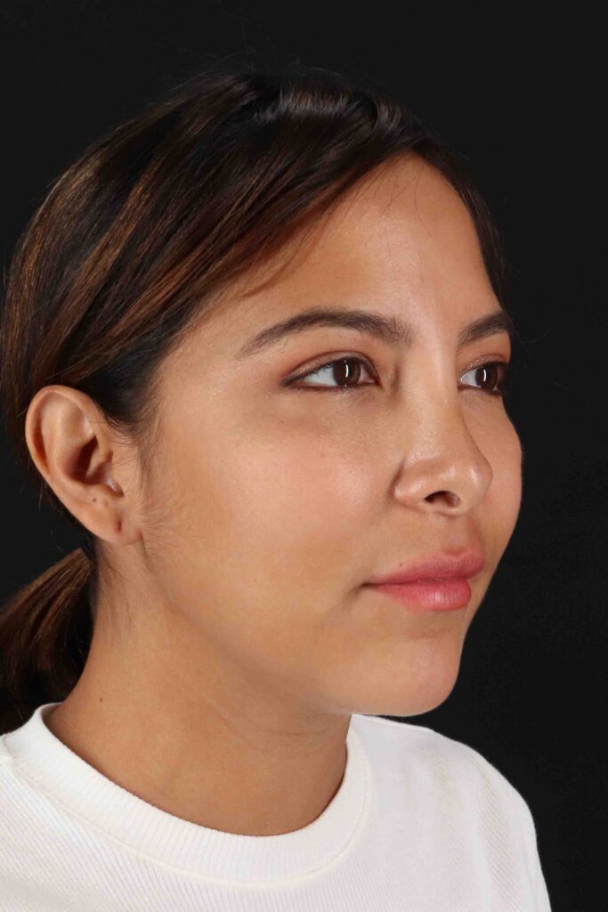 Before - right_oblique