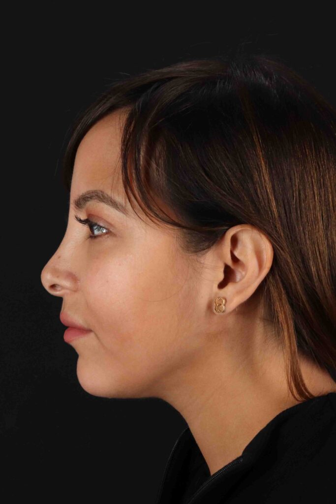 After - left_lateral