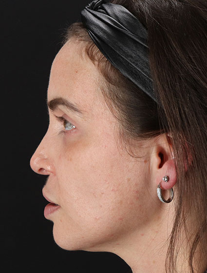 Before - left_lateral