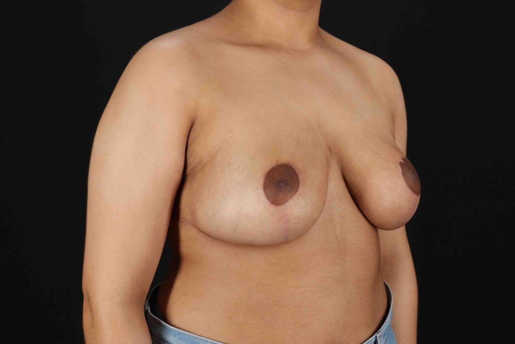 After - right_oblique