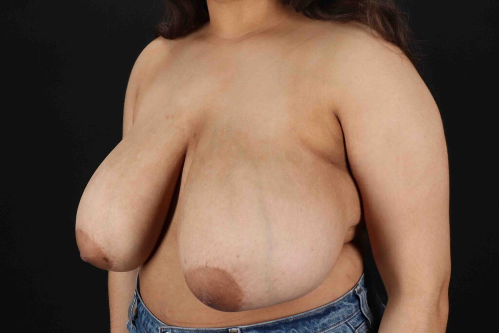 Before - left_oblique