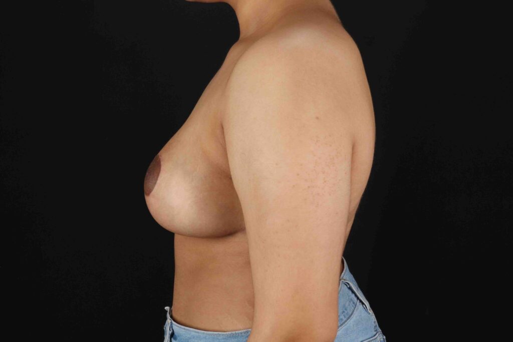 After - left_lateral