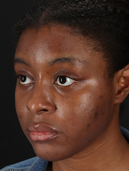 Before - left_oblique