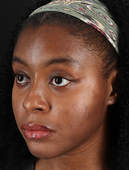 After - left_oblique