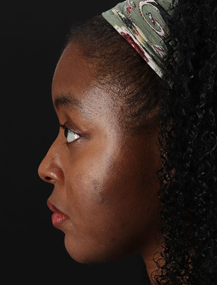 After - left_lateral